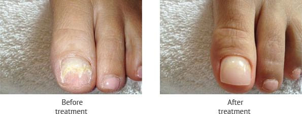 Thickened and Overgrown Nails  Nail Surgery Specialist Clinic In