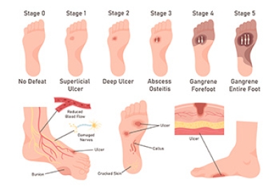 Grades of Diabetic Foot Ulcers