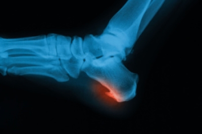 Definition of a Heel Spur