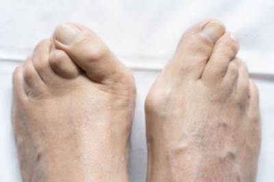 Different Types of Bunions and Treatments